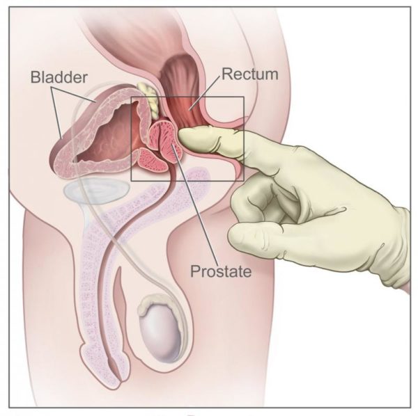 Prostatitis klostridia)